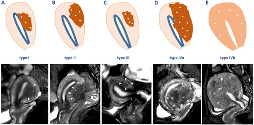 Figure 1. Schematic drawings of MRI classification of adenomyosis (upper) and the corresponding examples (lower). (A) Type I, intrinsic focal adenomyosis (arrows); (B) type II, extrinsic focal adenomyosis (arrows); (C) type III, intramural focal adenomyosis (arrows); (D) type IVa, diffuse adenomyosis with unilateral myometrium involved (arrows); (E) type IVb, diffuse adenomyosis with bilateral myometrium involved.