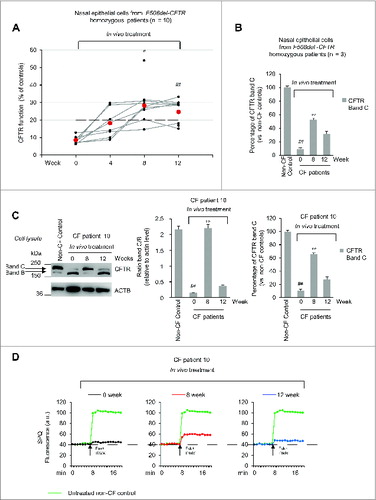 Figure 6 (See previous page). Effects of treatment on CFTR function and sweat chloride levels in vivo in F508del-CFTR homozygous patients. (A) Assessment of iodide efflux by a fluorescence assay (SPQ) upon stimulation with Fsk plus IBMX. Rate of iodide efflux in freshly isolated brushed nasal epithelial cells collected from all 10 F508del-CFTR homozygous patients before treatment (wk 0) and after 4, 8 and 12 wk of treatment. Values are expressed as percentage of 5 non-CF healthy controls at each time point (wk 0, 4, 8 and 12). Red markers indicate mean values. Dashed line indicates 20% of rescued function. The analysis was performed on at least 50 cells per sample and per experiment at each time point. Mean ± SD of 3 experiments for each sample, #P = 0.0003 and ##P = 0.0002 versus wk 0. (B and C) Effects of treatment on CFTR protein levels in freshly isolated nasal epithelial cells. (B) Mean values of CFTR Band C in patients No. 5, 6 and 10 of Table 1. The values are expressed as percentage of non-CF healthy control (considered as 100% of value). Mean ± SD of triplicates of independent experiments per each patient's sample; ##P < 0.01 compared to non-CF healthy control, °°P < 0.01 versus wk 0 (ANOVA). (C) Left Immunoblot detection of CFTR in whole lysates. ACTB was used as loading control. Representative blot of one non-CF control and 1 out of 3 patients with CF (No. 10 of Table 1) analyzed before and after 8 and 12 wk of treatment in vivo. Right, densitometric measurement of CFTR expressed as ratio of Band C /B and as percentage non-CF healthy control normalized to ACTB levels. Mean ± SD of triplicates of independent experiments; ##P < 0.01 compared to non-CF healthy control, °°P < 0.01 versus wk 0 (ANOVA). (C) Assessment of iodide efflux by a fluorescence assay (SPQ) upon stimulation with Fsk plus IBMX in freshly isolated nasal epithelial cells collected from patient No 10 before treatment and after 8 and 12 wk of treatment in vivo.