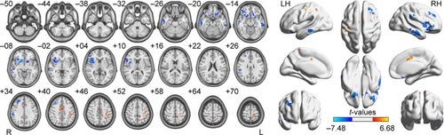 Figure 2 Spontaneous brain activity in the monocular blindness and healthy control groups.