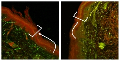 Figure 2 A skin biopsy sample before and after treatment with topiramate shows an increase in the intraepidermal nerve fiber density (epidermis indicated by box at arrow) and dendritic length after treatment.