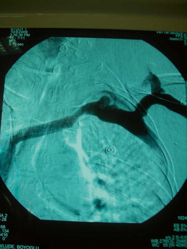 Figure 2. Post-procedural (PTA + stenting) left brachiocephalic vein.