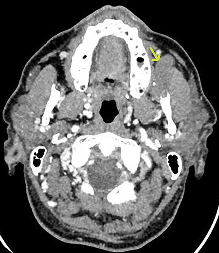 Figure 1 CT findings of our representative case of a 54-year-old man with MT in left buccal space. Axial contrast-enhanced CT image demonstrates a well circumscribed solid oval mass (yellow arrow) with soft tissue density, a calcified focus and no significative contrast enhancement after contrast medium administration.