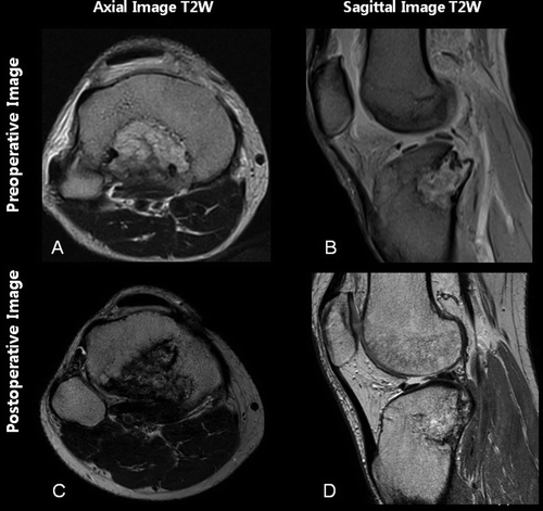 Figure 8. A representative case of benign fibrous histiocytoma on the proximal tibia. The tumor was shown to be located very close to the popliteal artery and tibial nerve on preoperative MRI (A and B). There was no neurovascular compromise after navigation-guided curettage, and post-operative MRI showed successful integration of the allogenic bone graft (C and D). Since we used a specially designed burr attached to the navigation apparatus, it was possible to monitor the burr tip in real time, thereby avoiding damage to the neurovascular bundle (E).