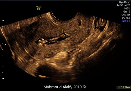 Figure 3 2DSHG image in a sagittal section of the uterus showing the cesarean scar niche depth.