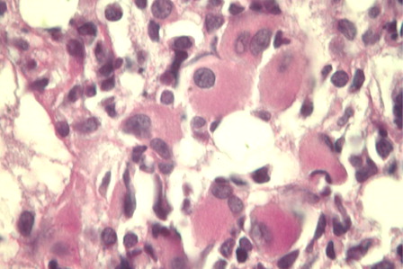 Figure 2. AML with inv(3)(q21q26.2). Bone marrow biopsy showing a marked increase of atypical small mono- and bilobated megakaryocytes (PAS, x400).
