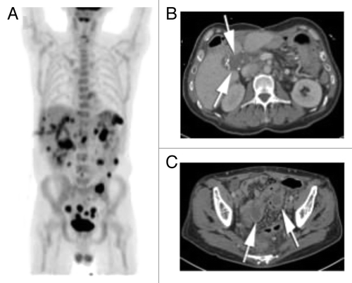 Figure 5. (A) PET maximum intensity projection (MIP) image on latest follow-up exam shows diffuse FDG activity scattered throughout the abdomen and pelvis, consistent with peritoneal metastatic disease. (B) Latest contrast enhanced CT scan show post-surgical changes in the right abdomen following colectomy, with soft tissue mass in the porta hepatis (arrows). There are biliary drainage catheters in place. The left subphrenic masses have resolved. (C) Contrast enhanced CT through the pelvis show 2 peripherally enhancing masses along the sigmoid colon, which were FDG avid (not shown) and consistent with metastatic disease.