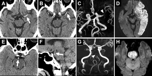 Figure 1 (A–D) An 82-year-old woman had hyperdense artery sign (HAS; arrows) with the highest Hounsfield units (HU) of 62 showing acute occlusion of the left middle cerebral artery (arrowhead) on MR angiography and a large area of infarction. (E–H) A 62-year-old man had HAS (arrows) with the highest HU of 66 showing acute occlusion of the basilar artery (arrowhead) on MR angiography and a large area of brainstem infarction.