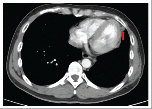 Figure 3. Five months later after surgery (March 2015), CT scan showed a 1.0 × 1.2cm left pleural nodule.