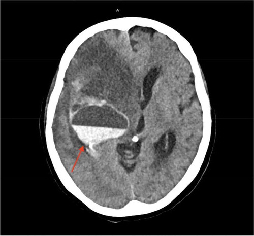 Figure 6. Computer topography of the head without IV contrast on day 18