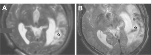 Figure 5 Magnetic resonance imaging scan of the damaged temporal lobe of a human that received neural stem cells labeled with magnetic nanoparticles.Notes: The magnetic resonance images show pre- (A) and post-implantation (B) of neural stem cells into the temporal lobe. The stem cells are labeled with the magnetic nanoparticle, Feridex (Ad-Vance Magnetics Inc, Rochester, IN, USA), coupled to a transfection reagent. No signal was detected at the lesion, labeled with an asterisk, before the injection; however, 1 day post-injection, a dark area was seen around the lesion, indicating the presence of the magnetic-labeled neural stem cells. Copyright © 2011. John Wiley and Sons, Inc. Reproduced from Cromer Berman SM, Walczak P, Bulte JW. Tracking stem cells using magnetic nanoparticles. Wiley Interdiscip Rev Nanomed Nanobiotechnol. 2011;3(4):343–355.Citation33