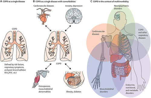 Figure 1 COPD and multimorbidity. This conceptual framework represents the most important change in disease concept since the ReviewCitation139 by Decramer and Janssens on COPD and comorbidities was published in the first volume of The Lancet Respiratory Medicine, and demands a shift in the management paradigm from an approach that focuses on COPD as a single disease of the respiratory system with comorbidities, to one in which COPD is viewed as a component of multimorbidity. (A) Previously COPD was seen as a single disease. (B) COPD and different comorbidities have generally gained attention because of the progress in understanding, but they were still viewed separately. (C) Patients with COPD and comorbidities should be considered as suffering from a multimorbid state, which should be treated as a whole. COPD=chronic obstructive pulmonary disease. FVC=forced vital capacity.