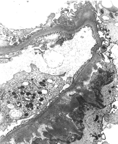 Figure 3. Electron micrograph showing fibrillary deposits in the sub-epithelial zone of the capillary wall. Original magnification ×5000.