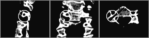 Figure 3. Sagittal, coronal and transverse CT slices of the pilot hole drilled with the aid of the template. The circles emphasize that the trajectory remained entirely within the pedicle.