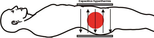 Figure 2. Capacitive hyperthermia system with external electrodes.