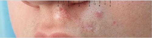 Figure 3 NSJ after eight sessions of cryotherapy.