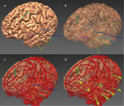 Figure 3. EpiNav generated electrode trajectories example implantation for a patient with a suspected left fronto-temporal onset. (a) Left fronto-lateral view of the cortex 3D model with the EpiNav generated implantation plan of 9 electrodes (multi-colored). (b) Transparent cortical model to demonstrate intracerebral course of the electrodes. (c) Superimposed vascular segmentation (red) derived from DSA injections of both right internal carotid and vertebral arteries. (d) Superimposed implanted electrodes (yellow) derived from post-operative CT.