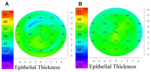 Figure 6 Epithelial thickness maps of the same (control) patient, same eye, as produced by two consequtive acquisitions. Both maps demonstrate a thicker epithelium over the pupil center. Different acquisitions (A and B) of the same eye may produce epithelium maps which may vary by an estimated ± 4 μm.
