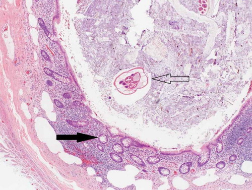 Figure 3. Histopathology. Solid arrow showing endometrial tissues, and the transparent arrow showing enterobius vermicularis in the lumen of appendix