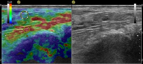 Figure 2 Sonoelastogram (left side) and B-mode ultrasound image (right side) of the TP tendon.