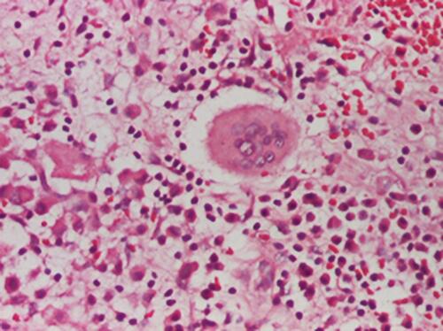 Figure 5 Polymorphic inflammatory infiltrate with polymorphonuclear, lymphocytes, plasmocytes and multinucleous extracellular giant cells (HE stain, x200).