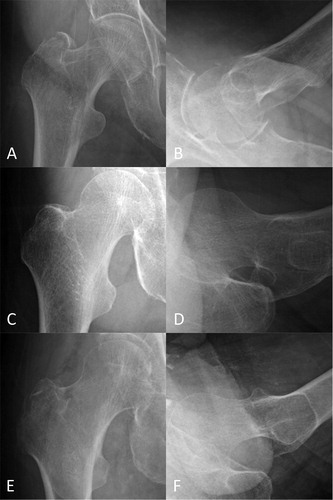 Figure 3. Representative radiographs of hip fractures. The AP (A) and lateral (B) radiographs of a trochanteric fracture, which the CNN misdiagnosed as a non-fracture, but all the orthopedic surgeon diagnosed correctly. The AP (C) and lateral (D) radiographs of a neck fracture, which 3 of the 4 orthopedic surgeons misdiagnosed as a non-fracture, but the CNN diagnosed correctly. The AP (E) and lateral (F) radiographs of a trochanteric fracture, which 3 of the 4 orthopedic surgeons misdiagnosed as a non-fracture or a neck fracture, but the CNN diagnosed correctly. AP = anteroposterior; CNN = convolutional neural network.
