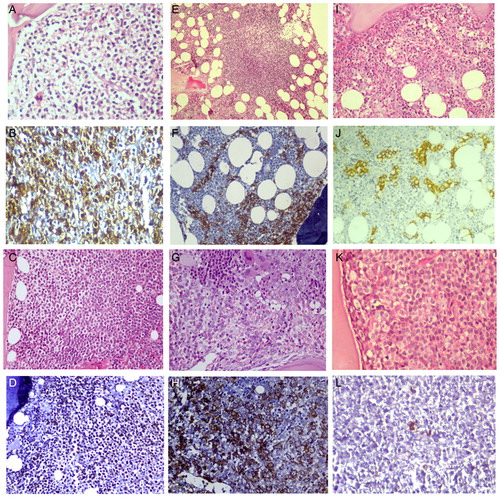 Figure 3. The morphology and salient immunohistochemistry findings of mature lymphoid neoplasms in bone marrow trephine biopsy. HCL showing typical ‘fried egg’ appearance (A) [Haematoxylin and eosin (H&E), 40x] and cytoplasmic positivity for CD72 (DBA.44) (B) [IHC, 40x]. MCL showing diffuse infiltration of bone marrow (C) [H&E, 40x] with nuclear positivity for cyclin D1 (D) [IHC, 40x]. SMZL showing nodular lymphoid infiltrate (E) [H&E, 10x] with intrasinusoidal and interstitial infiltrate highlighted by CD20 (F) [IHC, 20x]. DLBCL showing diffuse infiltration by large atypical lymphoid cells (G) [H&E, 40x] which are positive for CD20 (H) [IHC, 40x]. Intravascular large B cell lymphoma showing scattered atypical large cells (I) (H&E, 40x), the intrasinusoidal nature of which is highlighted by CD20 (J) [IHC, 40x]. Diffuse infiltrate of atypical large lymphoid cells with prominent eosinophilic nucleolus (K) [H&E, 40x], which are CD20+ CD5+ CD10− (not shown) and Cyclin D1− (L) [IHC, 40x] raising a differential diagnosis of cyclin D1 negative blastoid MCL and CD5+ DLBCL.