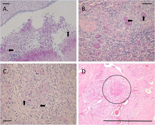 Figure 4. Photomicrographs of sections from tissues from a dog with disseminated Rasamsonia argillacea species complex infection: (A) renal pelvis with numerous fungal organisms (arrows) (periodic acid-Schiff; bar = 100 µm); (B) splenic parenchyma showing multinucleate giant cells with fungal organisms within the cytoplasm (arrows) (periodic acid-Schiff; bar = 100 µm); (C) lymph node cortex with numerous extracellular fungal organisms (arrows) (periodic acid-Schiff; bar = 100 µm); and (D) vertebrae, showing large regions of granulomatous inflammation (circle) surrounding larger blood vessels (H&E; bar = 100 μm).