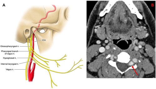 Figure 8 (A) Lower cranial nerves traveling adjacent to the internal carotid artery. (B) Patient presenting with C5 radiculopathy is found to have a prominent left vertebral artery pseudoaneurysm compressing the nerve roots at C5 level (shown by the red arrow).