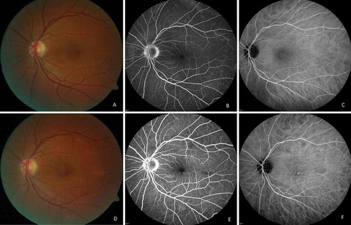 FIGURE 2. (A)Color photograph of the left eye. (B) Fluorescein angiographic image. (C) indocyanine green angiographic image before treatment: slight dye leakage at the optic disk, small foci of inflammation at the periphery. (D) Color photograph. (E) Fluorescein angiographic image. (F) Indocyanine green angiographic image after 6 months of treatment: decreased severity of inflammation.