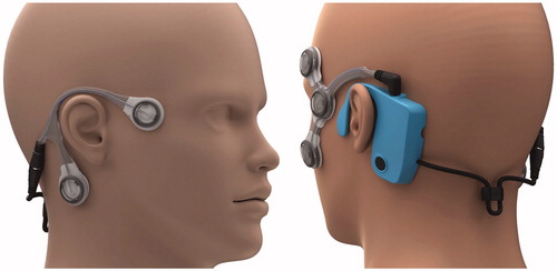 Figure 1. A picture showing how the CAVA® device looks when worn on the face. The device consists of a reusable logging module that sits behind the left ear, and two single-use electrode mounts that attach to the face by way of five ECG electrode pads. Two electrode pads are placed at the outer canthi of each eye to record horizontal eye movements, and two are placed above and below one eye to record vertical eye movements. A fifth electrode beneath the right ear provides a reference voltage.