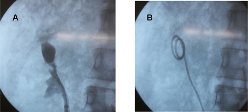 Figure 2 At the end of the procedure, a contrast study was performed and a double-J stent was retained inside the diverticulum. (A) Diverticular neck after widening. (B) Upper coil of double-J stent was in the diverticulum.