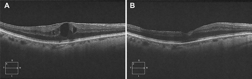 Figure 1 Representative optical coherence tomography images from an 83-year-old male patient with ERM in the right eye. (A) Pre-operation. (B) Post-operation.