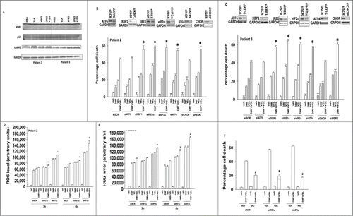 Figure 7. Endoplasmic reticulum stress pathways regulate the cellular response to DMF and velcade treatment. (A) GBM cells (patients 2 and 3) were treated with DMF (5 μM), velcade (10 nM) or the drug combination. Cells were isolated 12 h after exposure and subjected to SDS PAGE followed by immunoblotting to determine the expression and phosphorylation of the indicated proteins (n = 3). (B) GBM cells (patient 2) and (C) GBM cells (patient 3) were transfected with siRNA molecules to knock down the expression of: ATF6; XBP-1; IRE1α; eIF2α; ATF4; CHOP or with a scrambled siRNA (siSCR). Thirty 6 h after transfection cells were treated with DMF (5 μM), velcade (10 nM) or the drug combination. Cells were isolated 24 h after treatment and viability determined by trypan blue exclusion assay (n = 3, +/− SEM) *P < 0.05 greater than corresponding value in siSCR cells. (D and E) GBM cells (patient 2/3) were transfected with siRNA molecules to knock down the expression of: IRE1α; eIF2α or with a scrambled siRNA (siSCR). Thirty 6 h after transfection cells were treated with DMF (5 μM), velcade (10 nM) or the drug combination. The levels of reactive oxygen species in cells was determined 3 h after drug exposure using DCFH-DA. Data are plotted as the –Fold increase in ROS levels, with basal DCFH-DA fluorescence subtracted (n = 3, +/− SEM) *P < 0.05 greater than corresponding value in siSCR cells. (F) GBM cells (patient 2/3) were transfected with siRNA molecules to knock down the expression of: IRE1α; eIF2α or with a scrambled siRNA (siSCR). Thirty 6 h after transfection cells were pre-treated with N-acetyl cysteine (10 mM) and then treated with DMF (5 μM), velcade (10 nM) or the drug combination. Cells were isolated 24 h after treatment and viability determined by trypan blue exclusion assay (n = 3, +/− SEM) #P < 0.05 less than corresponding value in siSCR cells.