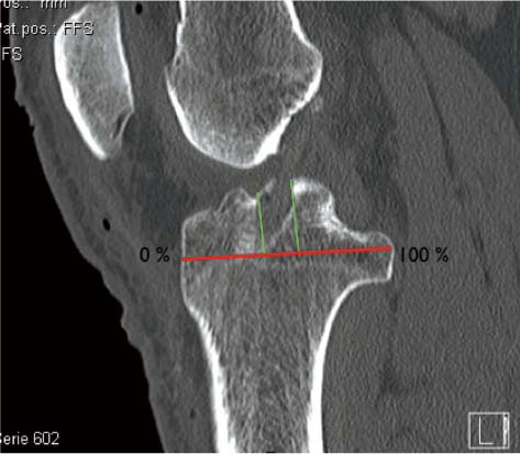 Figure 4. Measurement according to Stäubli (Stäubli and Rauschning, Citation1994) on the sagittal tibial CT reconstruction. The aperture of the tibial tunnel is compared to the line parallel to the joint line, through the most anterior and posterior points of the intracondylar tibial plateau.