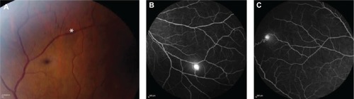 Figure 7 Fundus photograph, fluorescein angiogram.