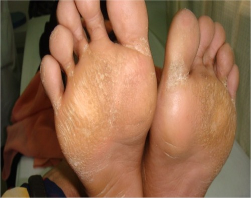 Figure 3 Plantar hyperkeratosis involving plantar aspect of feet.