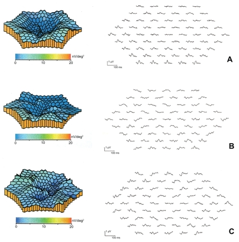 Figure 3 3D topographic plot and mf-ERG traces of the same eye at presentation (A), 1 month after treatment (B) and 3 months after treatment (C). Before treatment the mf-ERG revealed a craterlike depression of the foveal and perifoveal area. Three months after treatment the mf-ERG showed an improvement of the electrical activity of the fovea (area 1) and perifovea (area 2).