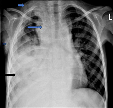 Figure 1 PA CXR taken at presentation showed widening of the mediastinum with right paratracheal, right axillary calcified Lymph nodes (blue arrows) and air space opacity, effusion at right lower lung (black arrow).