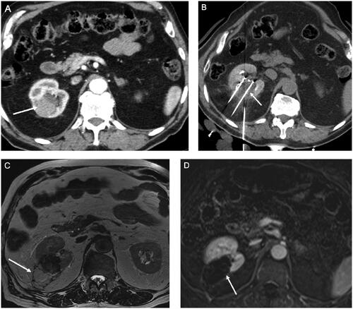 Figure 2. An 83 yo male who presented with a 44 mm clear cell carcinoma of the right kidney confirmed on percutaneous biopsy-proven was treated with cryoablation under computed tomography (CT) guidance. A) Axial contrast-enhanced CT images depicting a T1b CCC measuring 44 mm (arrow) the right kidney. B) Seven cryo-probes were used under CT guidance. CT images acquired intra-procedurally show a large hypodense ice-ball (arrow). C) T2 weighted MRI at 12-month follow-up demonstrates retraction of the ablation zone and a hypointense rim (arrow) around the ablation zone corresponding to cytosteatonecrosis. D) T1 weighted contrast-enhanced MRI obtained at 12 months months follow-up shows no remaining suspicious enhancement in the ablation zone (arrow).