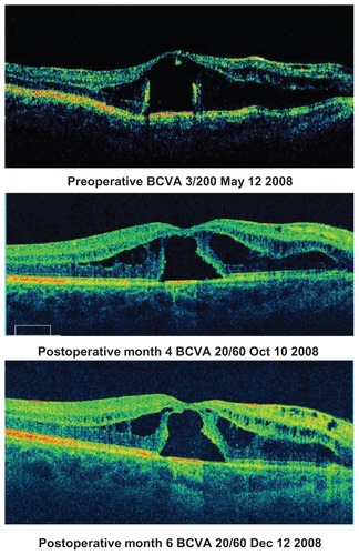 Figure 4 Good visual recovery after surgery with persistent intraretinal fluid.(Patient 17, Table 3)