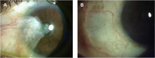 Figure 1 Clinical photograph of primary pterygium before surgery (A) and following superior conjunctival autograft (B).