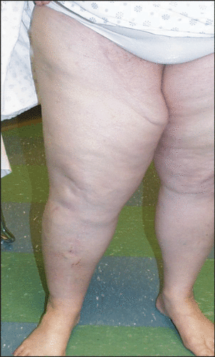 Figure 2. This figure demonstrates the long term morbidity after a hyperthermic limb perfusion. This patient has persistent lower extremity lymphedema 3 months after successful treatment for in transit melanoma metastases of the left lower extremity.