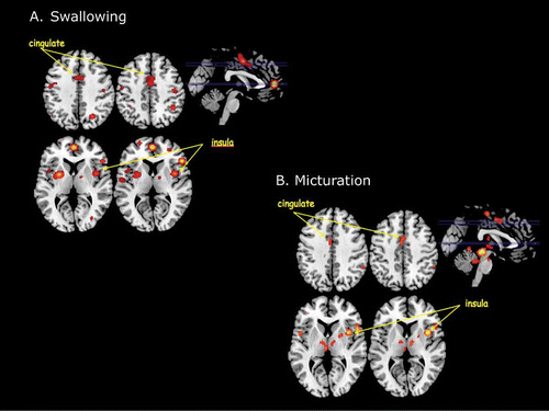 Figure 2. (A) Main results of an ALE meta-analysis of neuroimaging studies of swallowing. This analysis revealed a number of activation foci that survived conservative statistical correction (p < .05 corrected for false discovery rate). Among these were activations within the insular cortex and the dorsal mid-cingulate cortex. (B) Main results of an ALE meta-analysis of neuroimaging studies of micturition. Again this analysis revealed statistically significant foci of activation within the insular cortex and the dorsal mid-cingulate cortex.