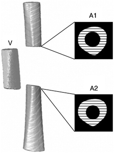Figure 5. A schematic indicating the cross-sectional areas of bone (black and white hatching) in the gap-bordering slices of the proximal (A1) and distal (A2) fragments. The comminution fragment (V) is also shown to the left of the atlas.