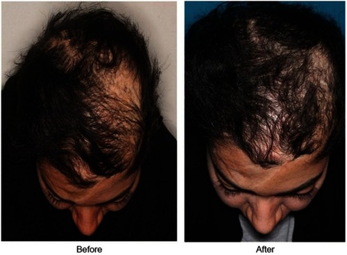 Figure 3 The case after 6 months of transplantation. The left picture relates to before and the right picture shows 6 months after transplantation.