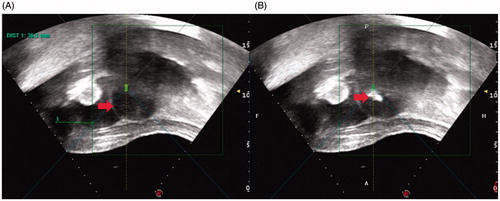 Figure 1. Monitoring ultrasound images obtained from a 42-year-old patient with an anteverted uterus. The bladder was filled with 150 mL of normal saline. (A) Pre-HIFU ultrasound image showed a 4.3 × 4.0 × 3.8 cm uterine fibroid located at the anterior wall of the uterus (arrow). (B) Intra-HIFU ultrasound image showed a significant greyscale change area in the fibroids (arrow).