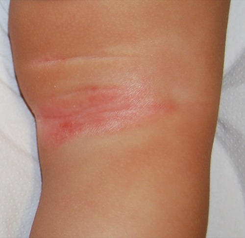 Figure 4 Inverse psoriasis of the right popliteal fossa in a 5-year-old child: moist, shiny, erythematous patches.