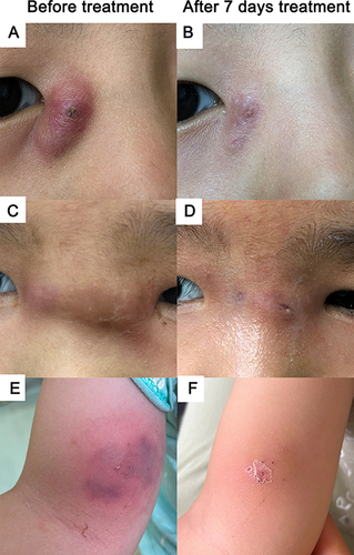 Figure 3 Case 4: A skin abscess on the nasal root of a 5-year-old child before (A) and after (B) 7 days of fire needle combined therapy. Case 8: A skin abscess on the inner corner of the eye of an 8-year-old child before (C) and after (D) 7 days of fire needle combined therapy. Case 12: A skin abscess on the arm of a 1-year-old child before (E) and after (F) 7 days of fire needle combined therapy. (All three patients received two needle treatments, with a 3-day interval between the second treatment and the first).