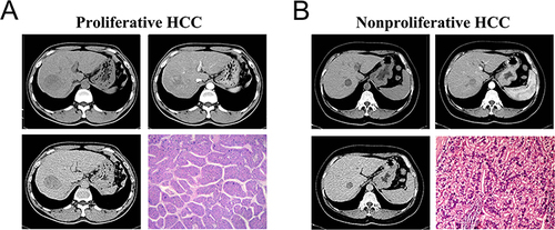 Figure 2 (A) Images showing a case of proliferative hepatocellular carcinoma in the 7th segment of the liver of a 50-year-old man with cirrhosis. The lesion was 41 mm in size, with an oval shape, and without satellite nodules on the CT images. CT image during the arterial phase displayed heterogenous enhancement. A washout appearance was observed in the delayed phase of the CT scan. These observations qualified as Liver Imaging Reporting and Data System category 5. Microscopic examination with hematoxylin and eosin staining confirmed the presence of the macrotrabecular-massive HCC subtype. (B) Images illustrating a case of nonproliferative hepatocellular carcinoma at the junction of the 7th and 8th segments of the liver of a 48-year-old woman without cirrhosis. The lesion was 22 mm in size, with a round shape, and without satellite nodules on the CT images. CT image during the arterial phase CT image showed moderate enhancement, while a washout appearance was noted during the delayed phase. These observations qualified as Liver Imaging Reporting and Data System category 5. Microscopic examination with hematoxylin and eosin staining confirmed the presence of the clear cell HCC subtype.