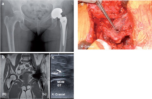 Figure 2. Case 2. Radiography, MARS MRI, ultrasound, and intraoperative images of gluteal musculotendinous damage. a. A pelvic radiograph showing a left-sided MOM total hip replacement in situ and highlighting the absence of the greater trochanter region of the left proximal femoral bone. b. A T1-weighted MARS MRI image in coronal section showing left-sided fatty atrophy of the gluteus medius and gluteus minimus muscles (grade 3) and thinning of the gluteus minimus tendon. c. Left lateral USS over the greater trochanter showing thin and hypoechoic tendons for the gluteus medius and gluteus minimus muscles. d. Photograph taken during revision surgery showing erosion of the left greater trochanter and gluteus medius muscle.MOM GT: the MOM femoral component (greater trochanter region); Gmed: gluteus medius tendon. Pathology is indicated by white arrows.
